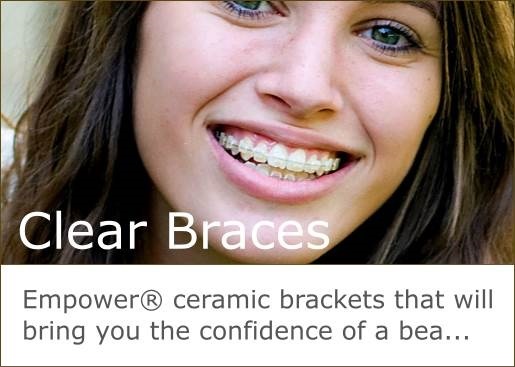 Empower ceramic brackets bring the confidence of a beautiful smile.
