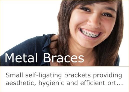 SPEED braces are small brackets providing aesthetic, hygienic and efficient orthodontics.